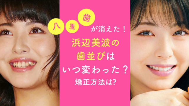 浜辺美波, 歯並び, 八重歯, 矯正, 可愛い, 君の膵臓を食べたい